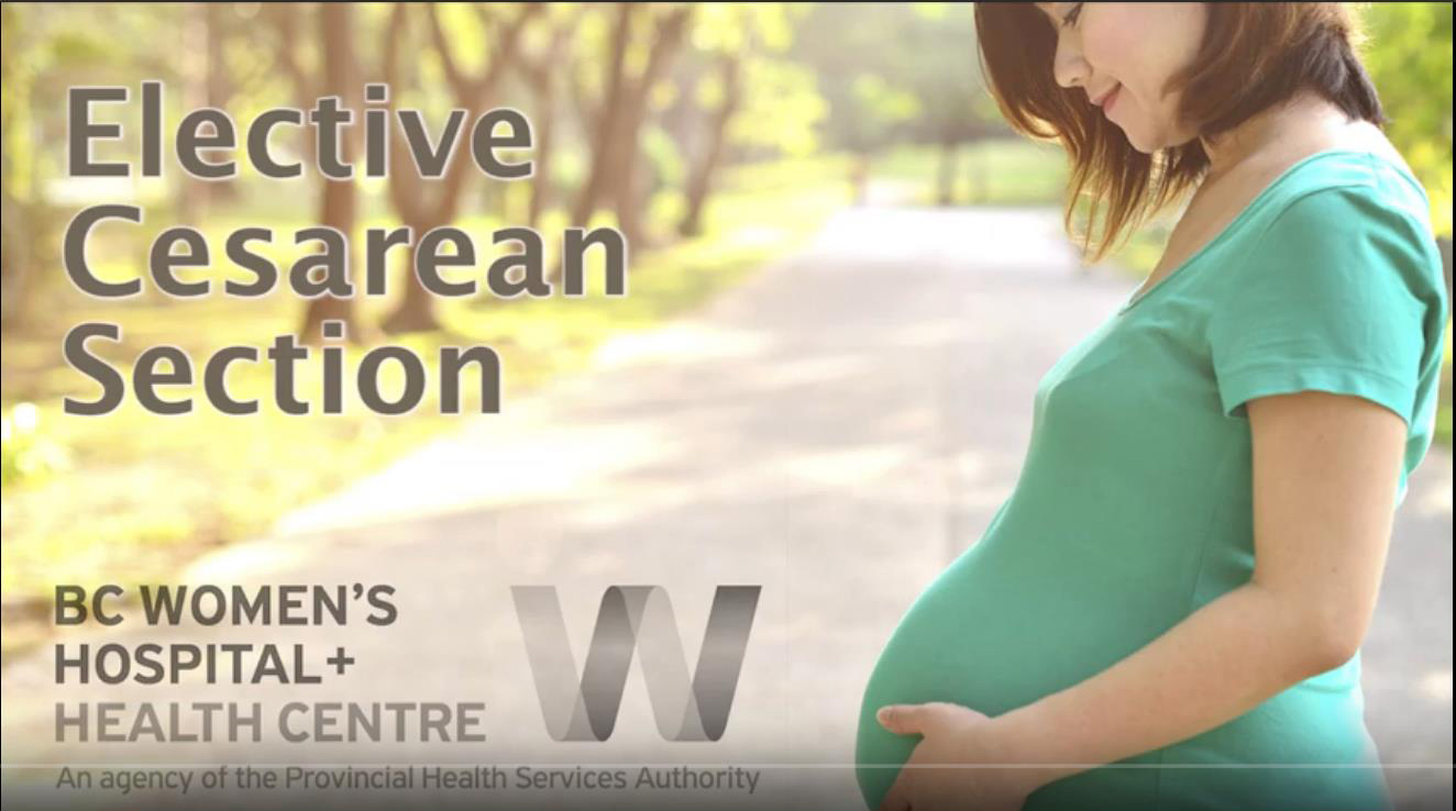 Elective caesarean section