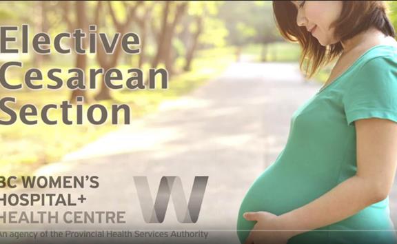 Elective Cesarean section video